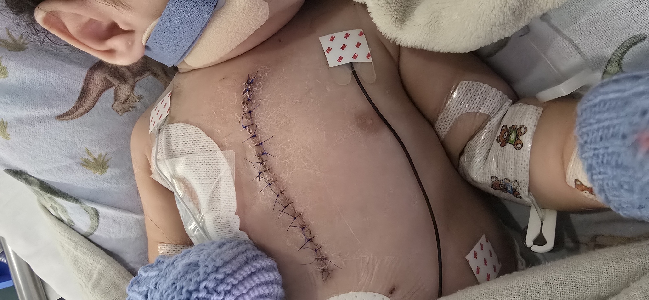 A warrior's scar. The open-heart surgery incision healing on his dinosaur sheets.